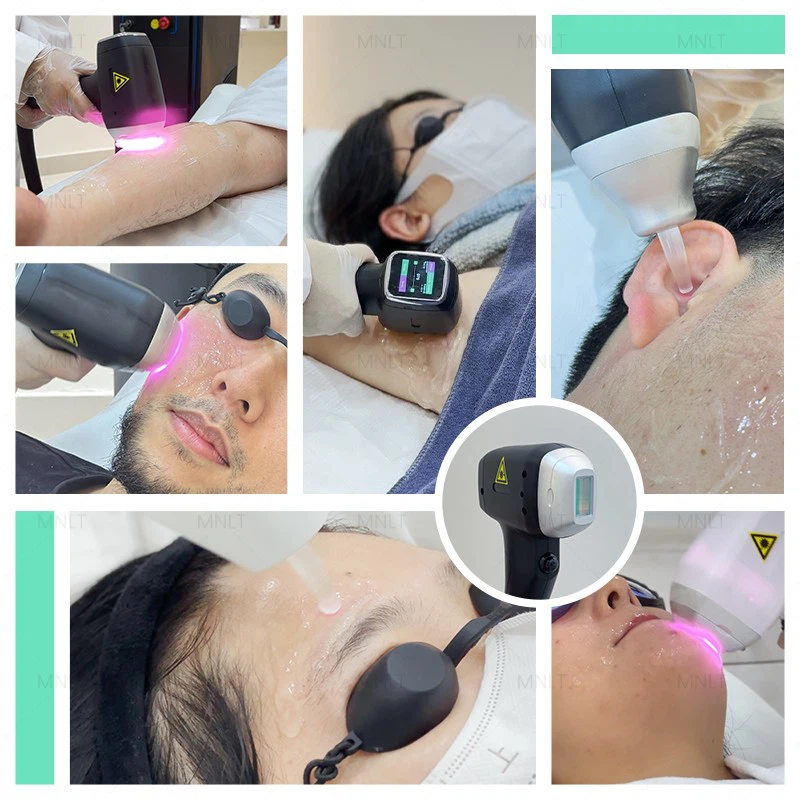 3 Wavelengths Diode Laser Hair Removal Machine