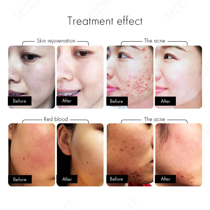 Multifunctional Laser Hair Removal Machine